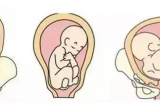 最常见的胎位异常难产竟然是“头位难产”？
