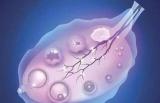 卵细胞库：41岁借卵试管成功案例分享，借卵试管也是自己的孩子