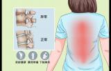 年轻人反复腰背痛治不好，警惕是否得了强直性脊柱炎
